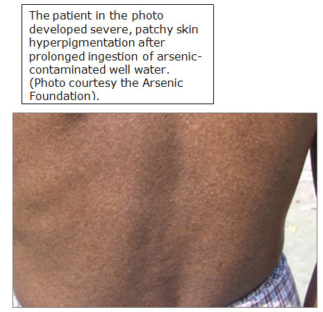 Arsenic Toxicity: What are the Physiologic Effects of Arsenic Exposure ...