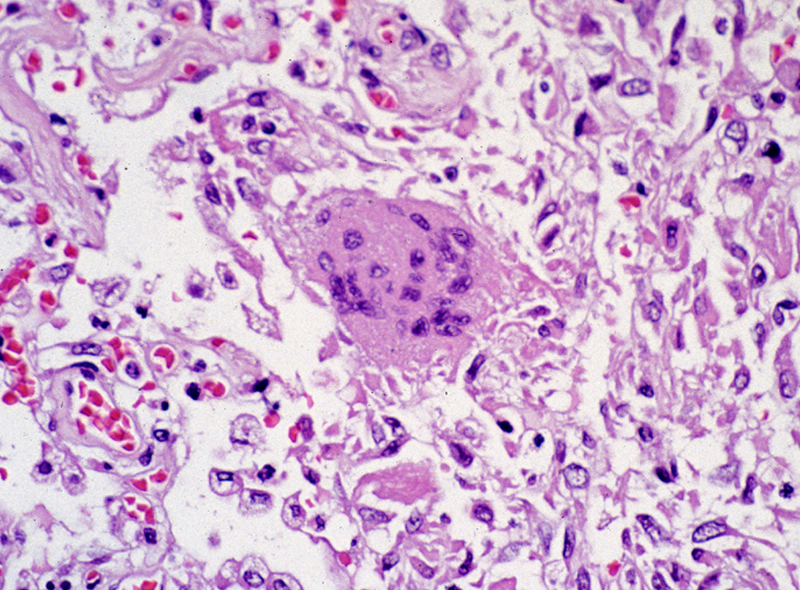 This photomicrograph reveals lung tissue pathology due to SARS.