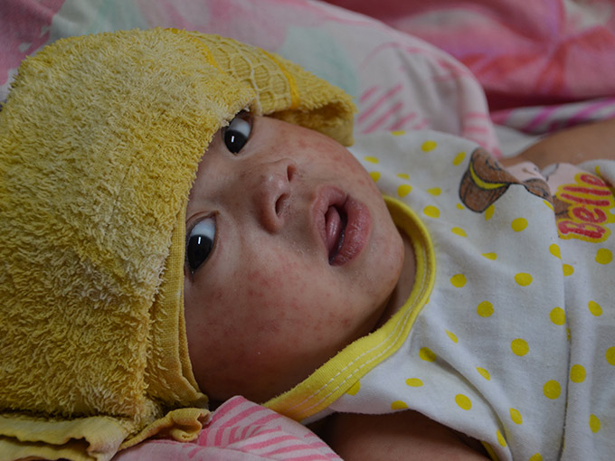 child with measles