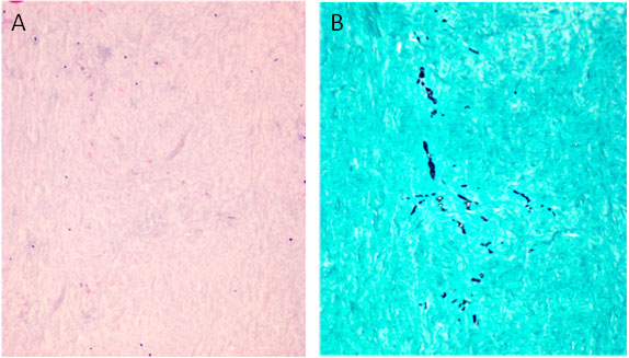 Microscopic views of tissues surrounding the spinal cord comparing the visibility of Arachnoiditis.