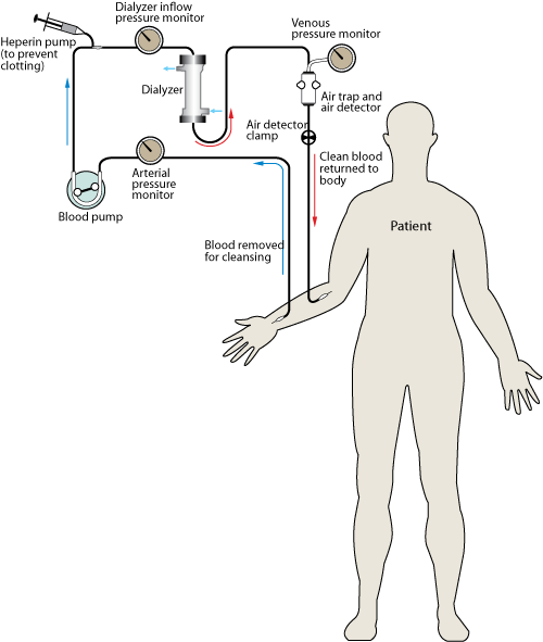 Figure detailing the process of hemodialysis in a patient: During hemodialysis, blood flows out of the body and by one side of a semi-permeable membrane. Dialysate, the fluid in a dialysis machine, flows by the opposite side of the membrane. Undesired waste in the blood flows into the dialysate, while bicarbonate (a needed solute that helps in pH balance) flows from the dialysate into the blood. The clean blood is then returned to your body. Removing the harmful waste and extra salt and fluids helps control blood pressure, pH balance, and plasma volume, similar to the results of a functioning kidney.