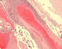 Microscopic examination of tissue from meningitis patients