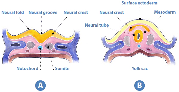 Neural tube defects