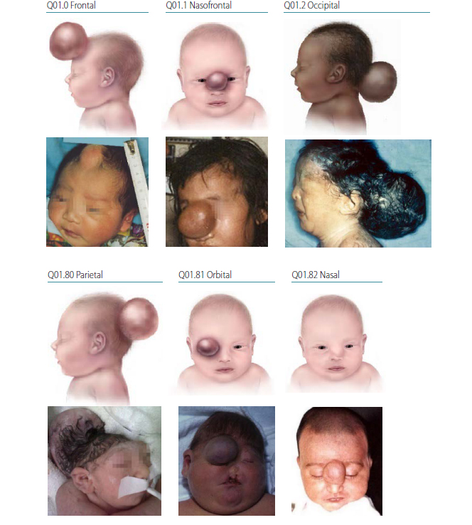 Fig. 4.6. Encephalocele