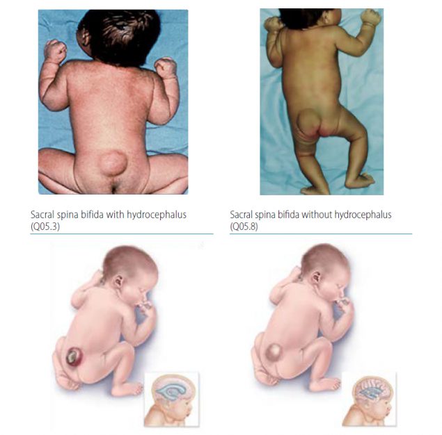 Fig. 4.11. Sacral spina bifida