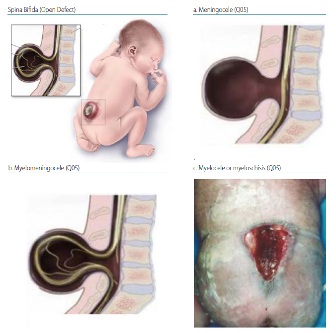 Fig. 4.7. Spina bifida