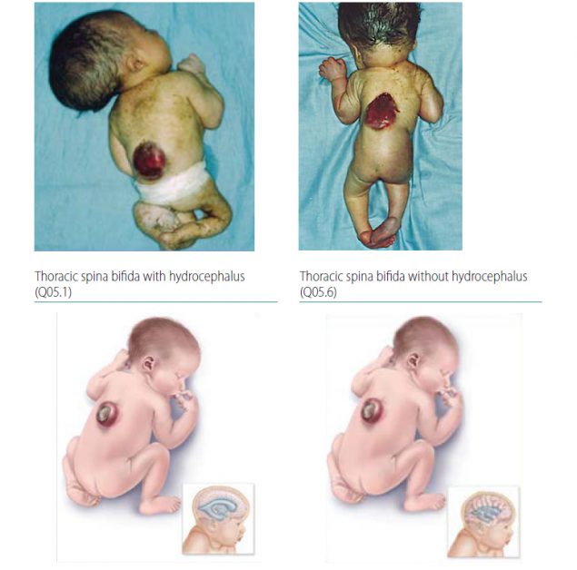 Fig. 4.9. Thoracic spina bifida