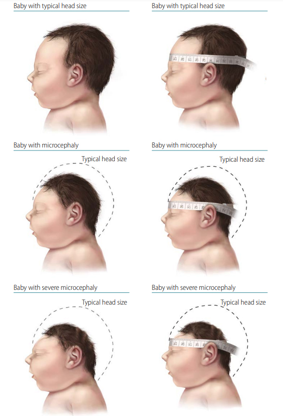 Microcephaly