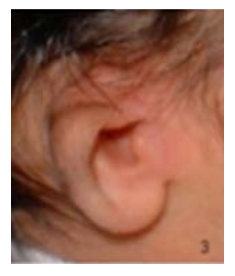 Baby with Microtia II Q17.22