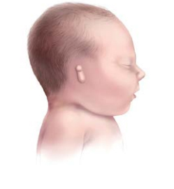 4.4 Congenital Malformations of the Ear | Birth Defects Surveillance ...