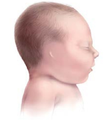 Graphic of child with Microtia Microtia IV or Anotia