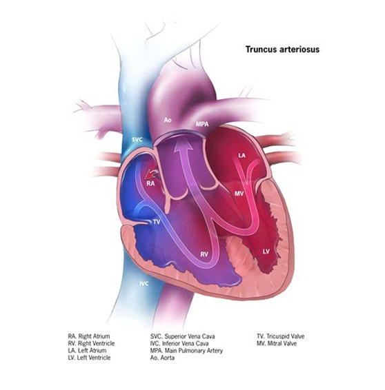 fig of truncus arteriosus