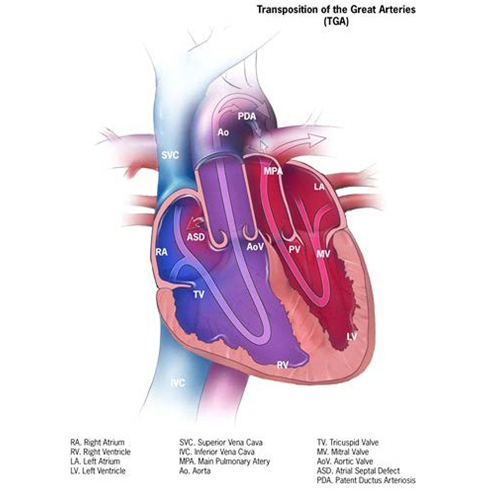 Transposition of great arteries