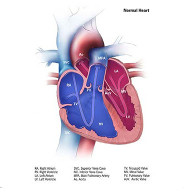 Tetralogy of Fallot