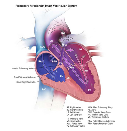 4.5 Pulmonary Valve Atresia (Q22.0) | CDC