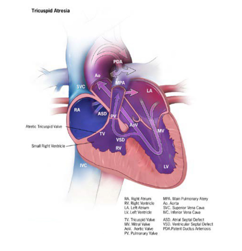 fig. 4.19. Tricuspid valve atresia