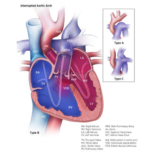 Interrupted aortic arch