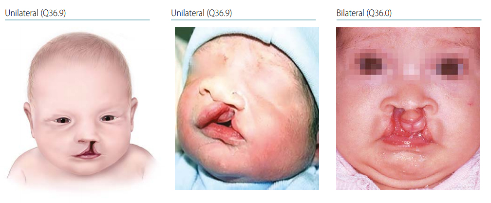 Fig. 4.24. Cleft lip