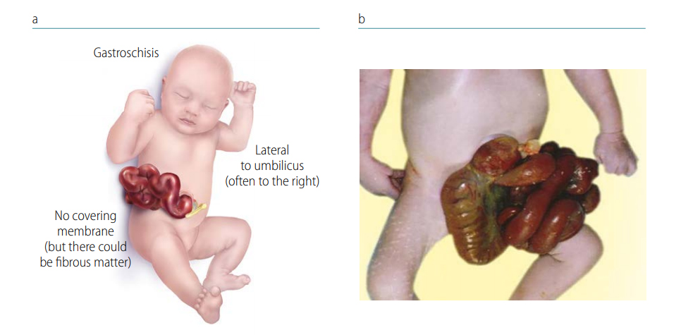 Fig. 4.43. Gastroschisis