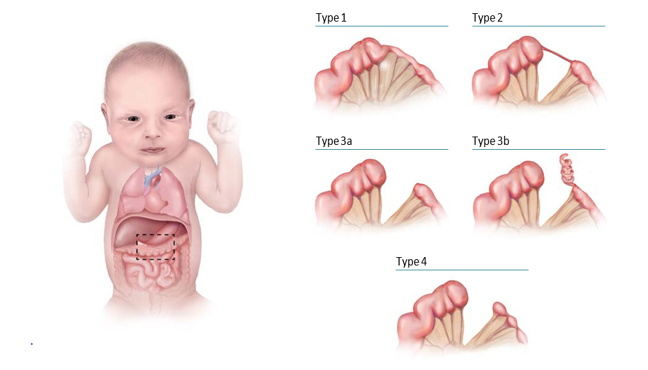 Main types of large intestinal atresia