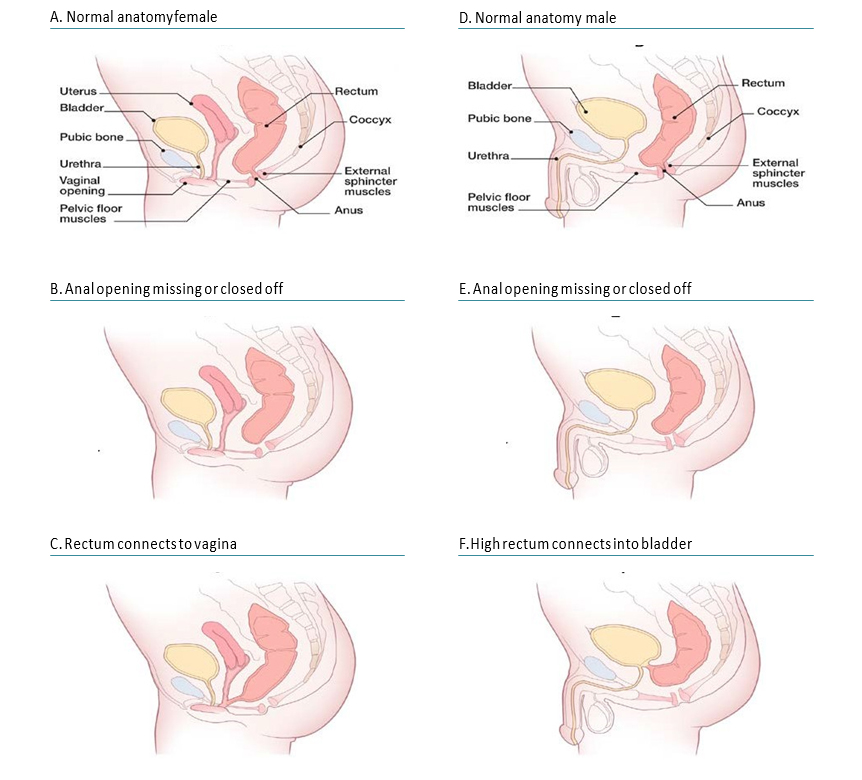 Fig 4.30. Anorectal atresia/stenosis