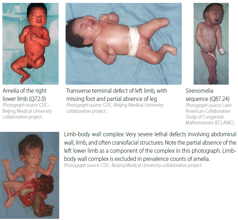 Distinguishing amelia from transverse limb deficiencies and sirenomelia (side-by-side comparison)