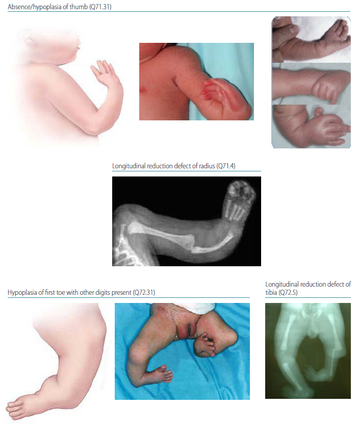 Fig. 4.39. Longitudinal preaxial