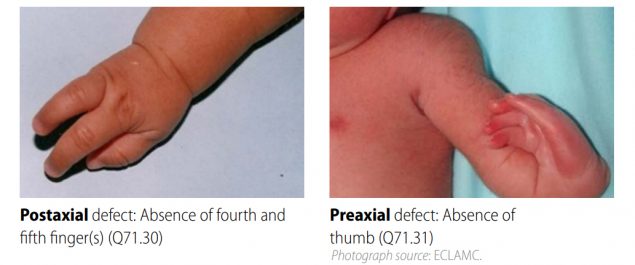 Distinguishing longitudinal postaxial defects from longitudinal preaxial defects (side-by-side comparison)