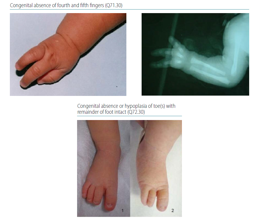 Fig. 4.40. Longitudinal postaxial