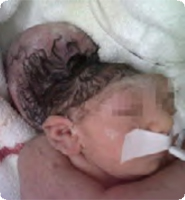 Photo of baby with Encephalocele