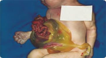 Photo of baby with Omphalocele