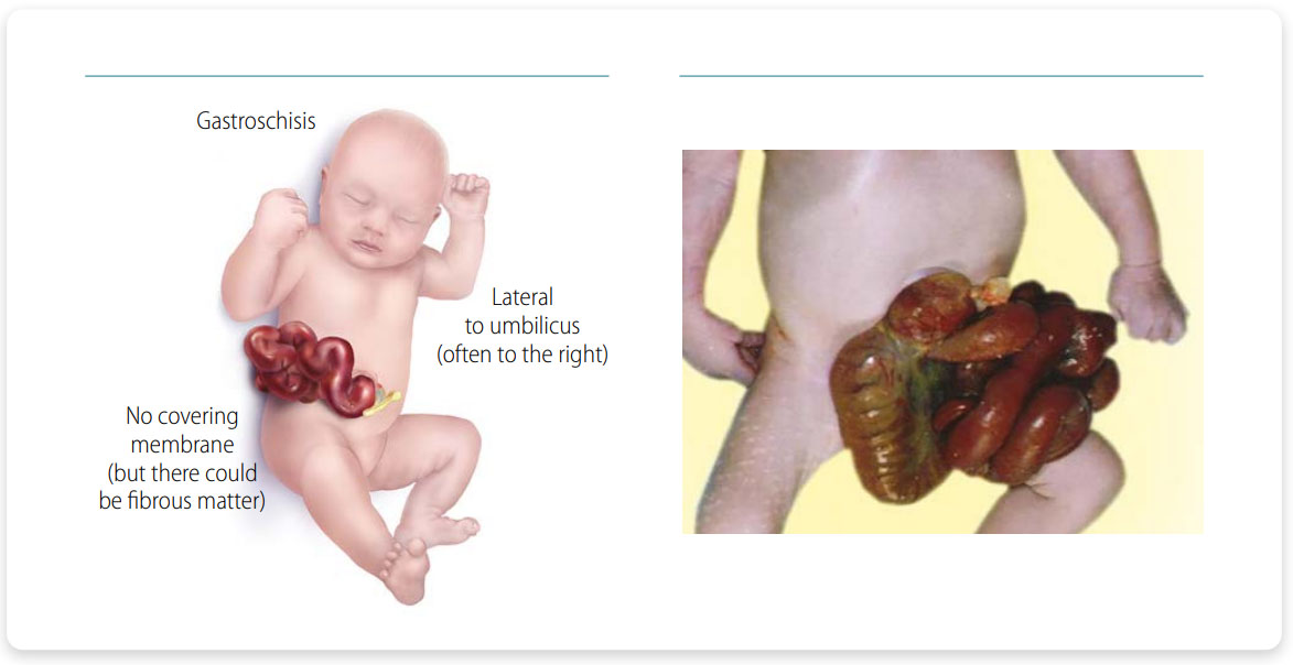 Gastroschisis