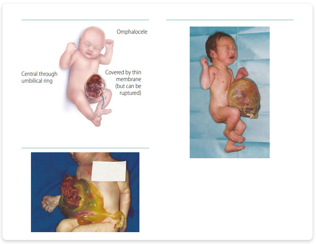 Omphalocele