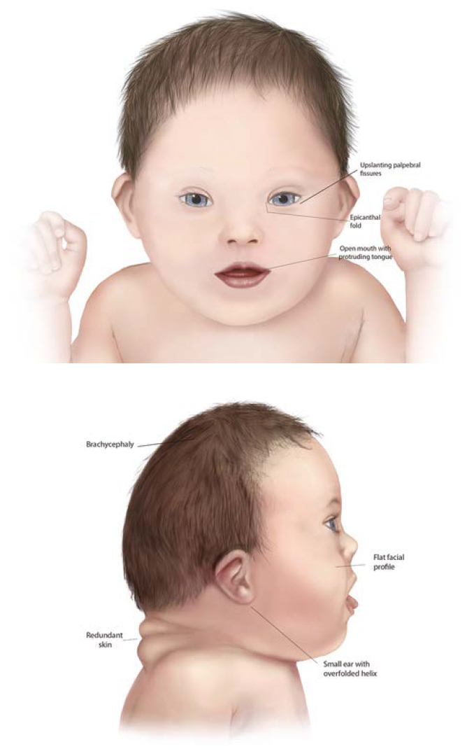 Common traits in trisomy 21 down syndrome