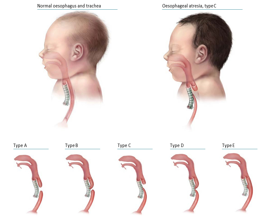 Oesophageal atresia/tracheo-oesophageal fistula