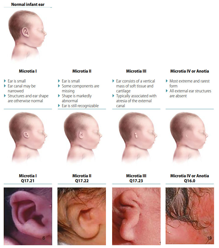 Microtia/anotia