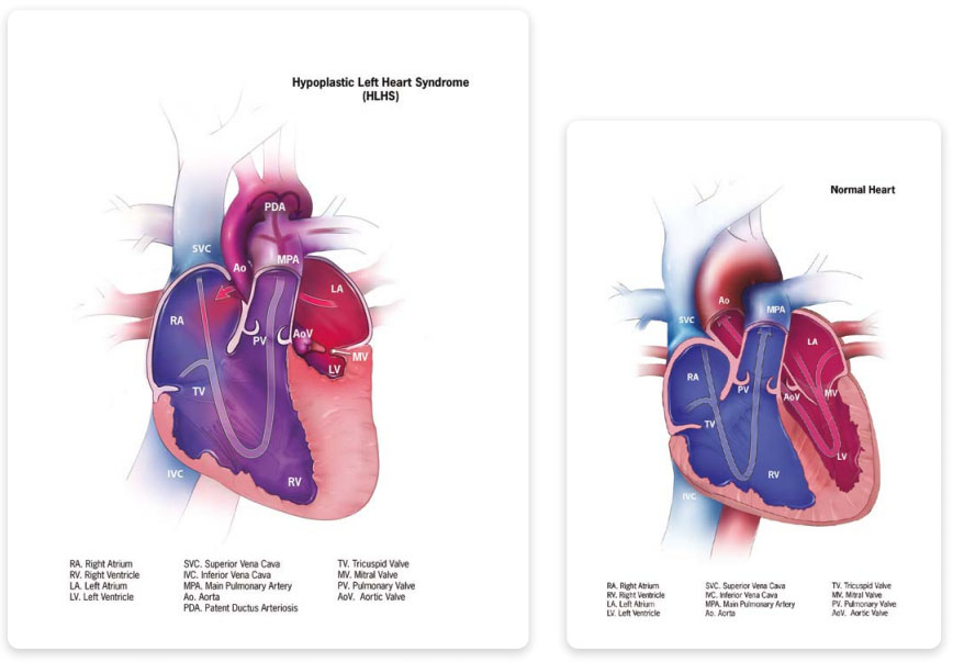 Hypoplastic left heart syndrome