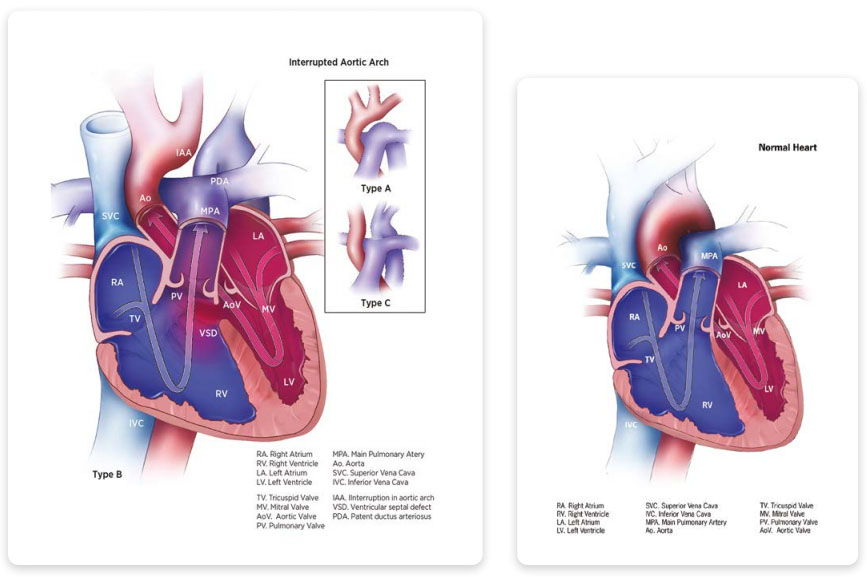 Interrupted aortic arch