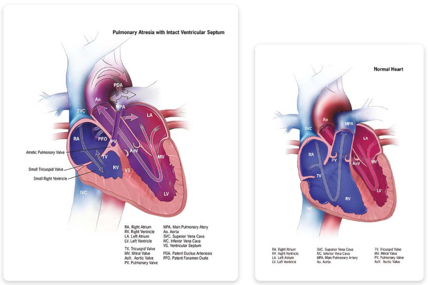 Congenital Heart Defects | CDC