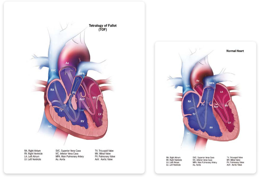 Tetralogy of Fallot