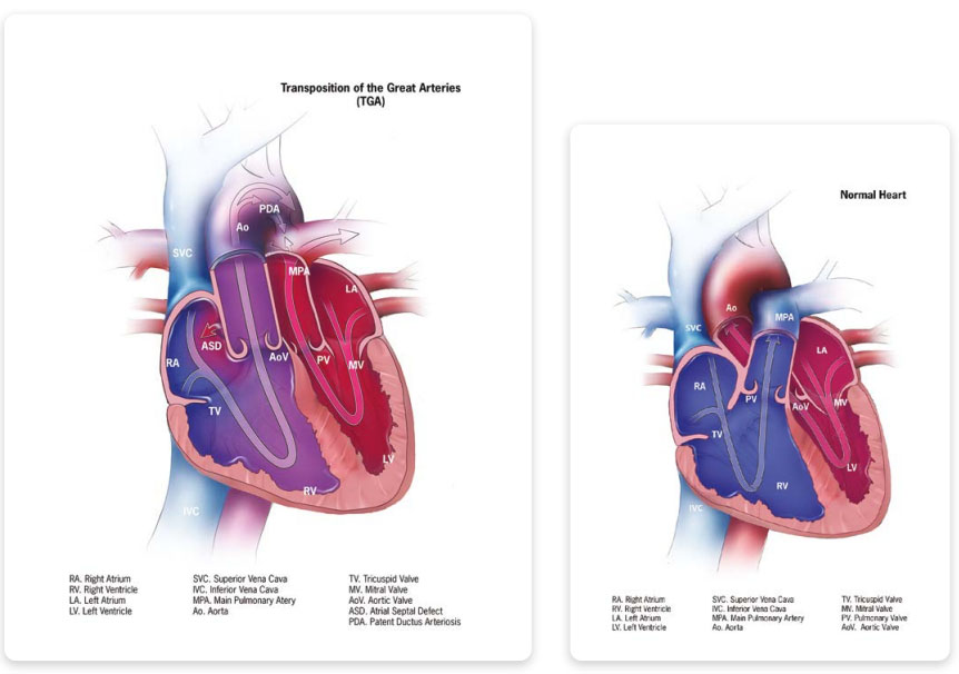 Transposition of great arteries