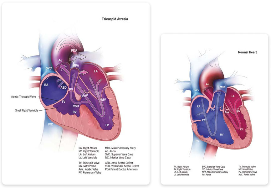 Tricuspid valve atresia