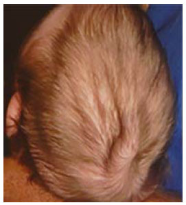 Posterior scalp view showing redundant scalp with folds (rugae).