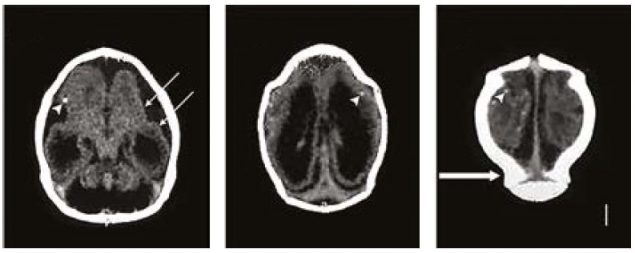 Computed tomographic (CT) scan