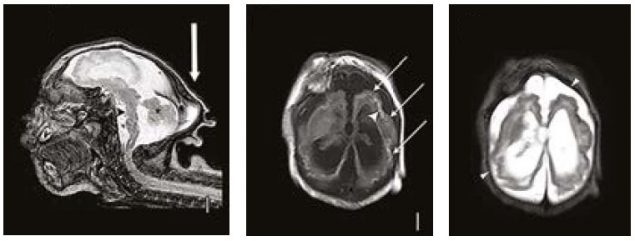 Magnetic resonance imaging (MRI) in infant with prenatal Zika exposure shows scattered punctate calcifications