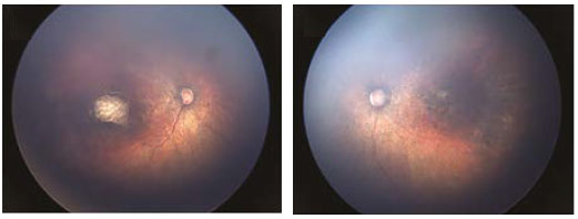 Fundus images of right and left eye: Optic nerve hypoplasia with the double-ring sign, gross pigmentary mottling, and chorioretinal scar in the macular region.