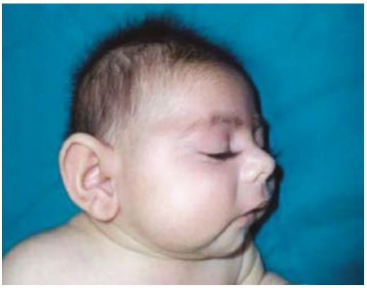 Congenital Cytomegalovirus