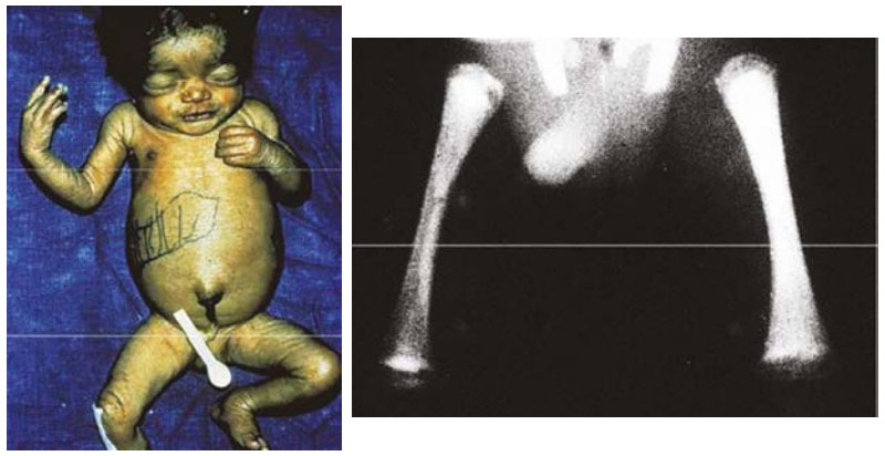 Congenital Syphilis