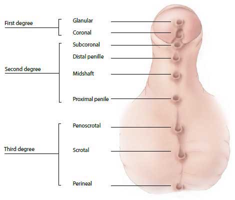 Hypospadias