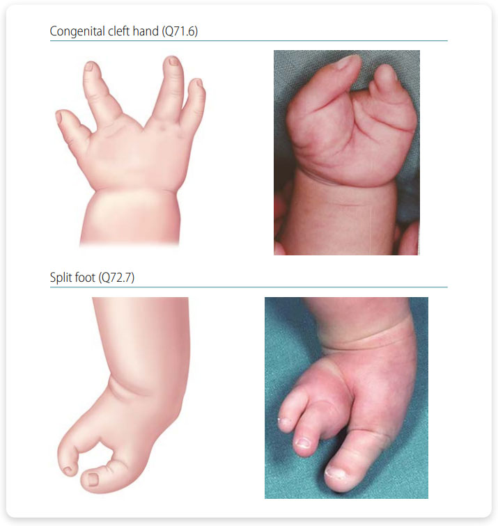 Longitudinal axial defects (split hand and foot)